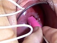 Uterus Inflation with Catheter and Cervix Fucking
